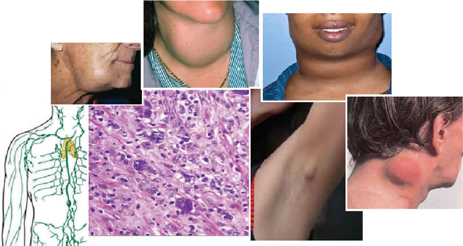 Lymphoma FPIMED